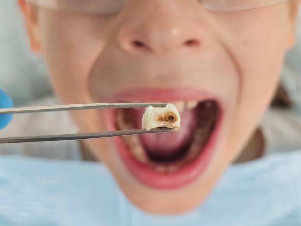 Best Emergency Dentist for Knocked-Out Tooth in Medina, NY
